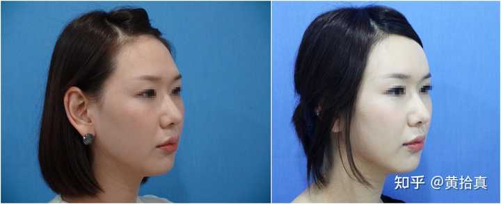 额头难看眉骨高怎么办 知乎
