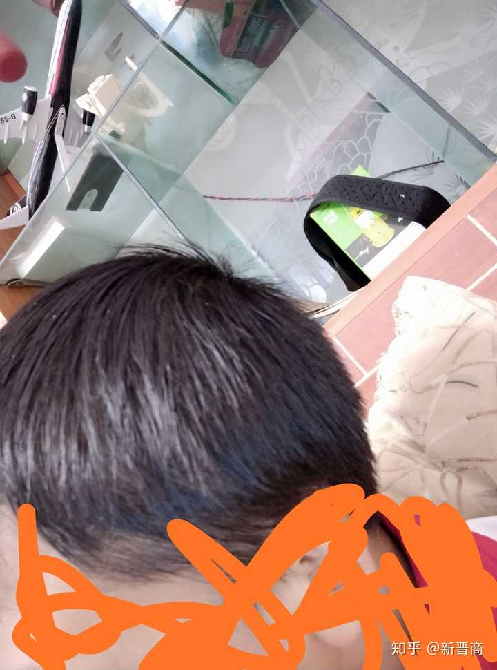 头发两侧稀疏怎么办啊头发还经常油两天不洗就非常油还很塌我才13岁