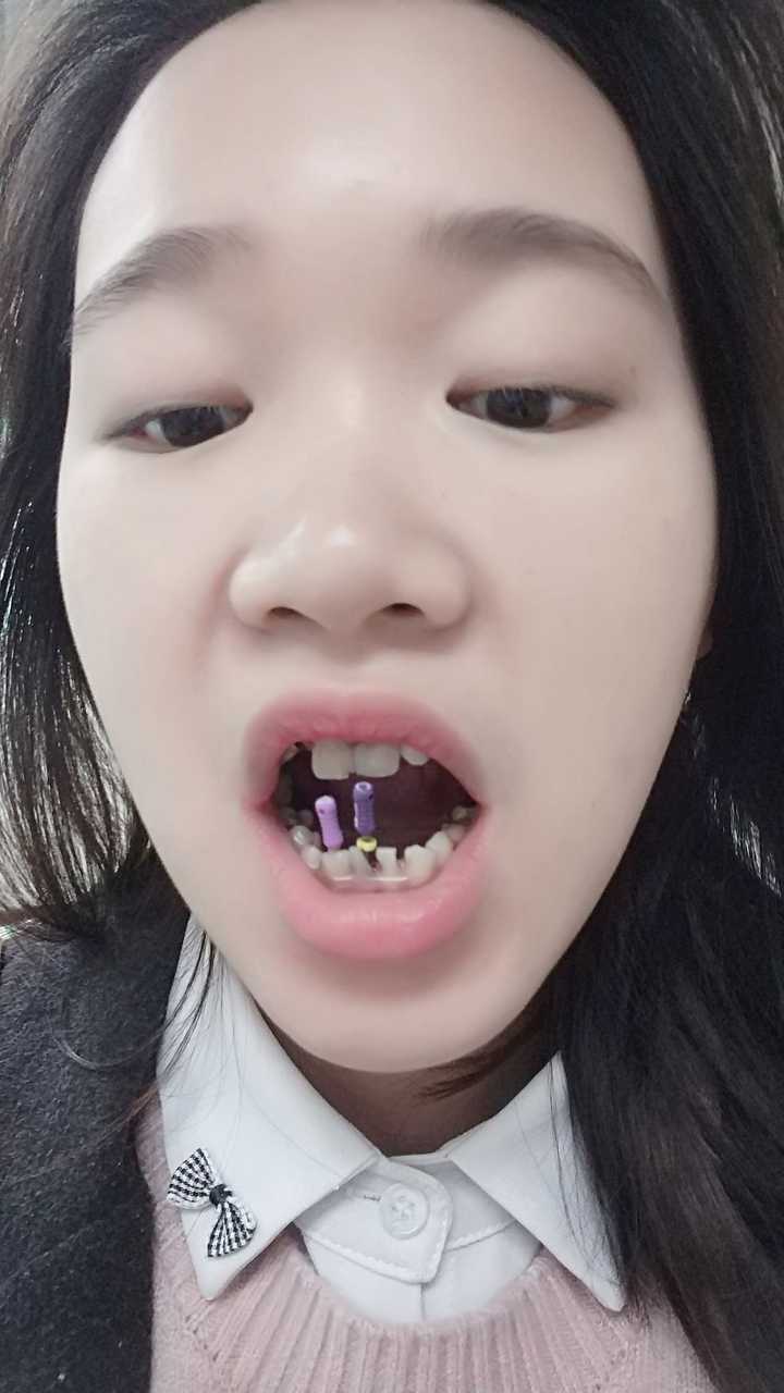 牙齿不好的同学(蛀牙,牙裂或者遗传性牙齿不好),一般是用什么心态对待