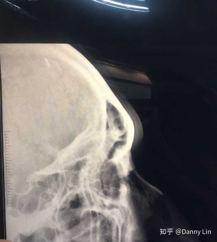 鼻骨骨折消肿后的复位是怎样进行的 如何矫正 知乎 鼻骨骨折消肿后的复位是怎样进行的 如何矫正 知乎