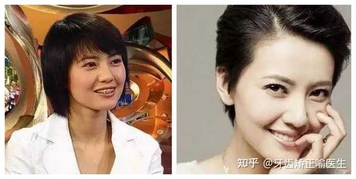 整牙成功是什么体验 知乎