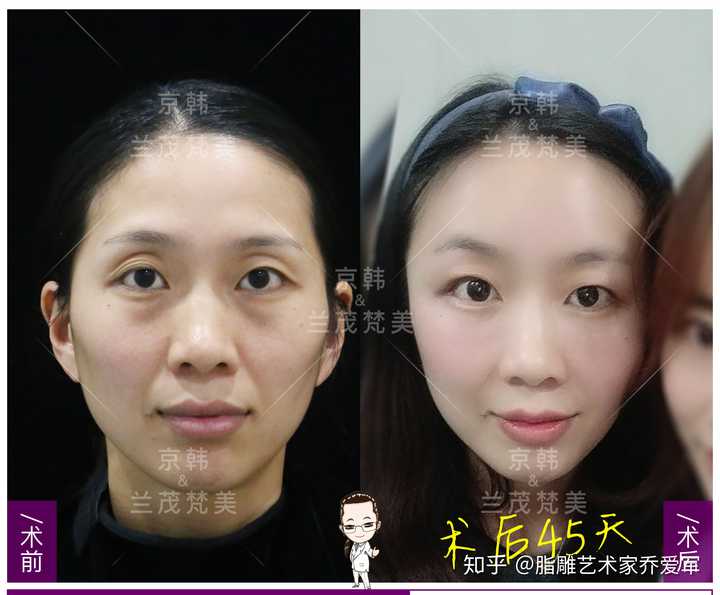 眼部填充脂肪能保持多久