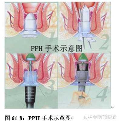 食管癌吻合器图片图片