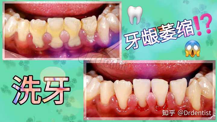 洗牙的过程是怎样的 洗牙后有哪些需要注意的 知乎 洗牙的过程是怎样的 洗牙后有哪些需要注意的 知乎