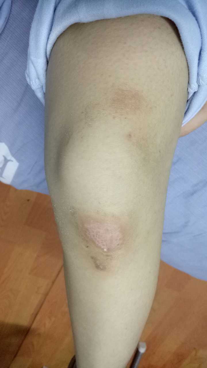 皮肤破后,流血结痂愈合是一个怎样的过程?