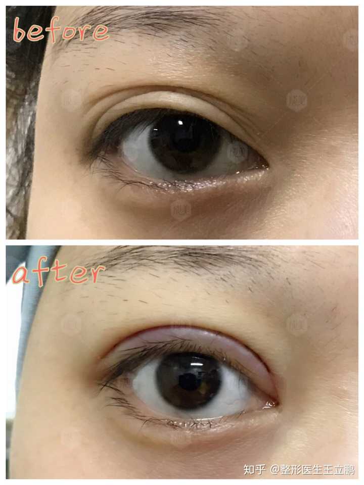 为啥我的双眼皮有这么多皱褶 好奇怪→_→? - 知乎
