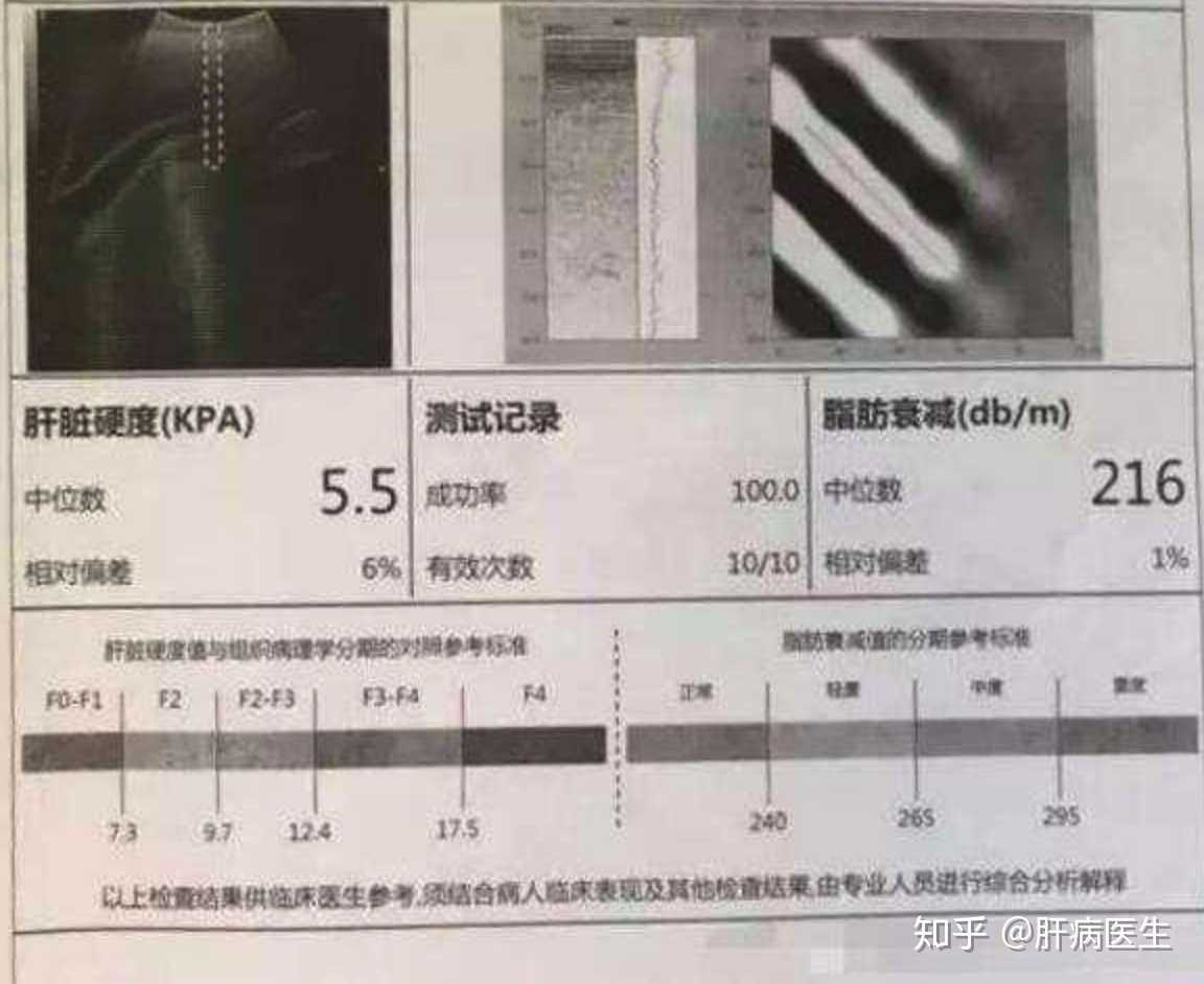  br> br>肝脏弹性检查是近几年发展起来的无创性肝脏纤维化的检 