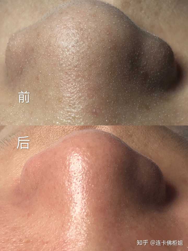 高中生用什么基础补水的水乳比较好啊,毛孔有点点大,然后有黑头,!