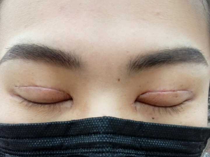 割双眼皮对外貌的改变大吗？