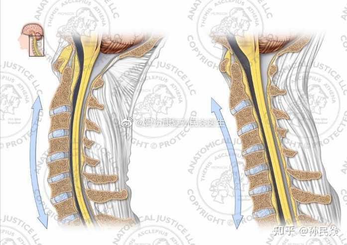 颈椎生理曲度反弓对比图片