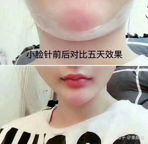 美颜猫 的想法: 6d小脸针让你轮廓更精致! - 知乎