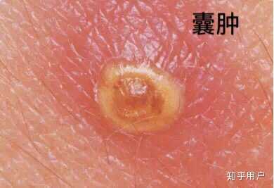 痘痘化脓了怎么办？ - 知乎