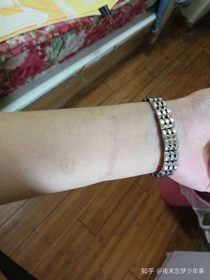 夏天如何不让别人轻易看出自残痕迹?