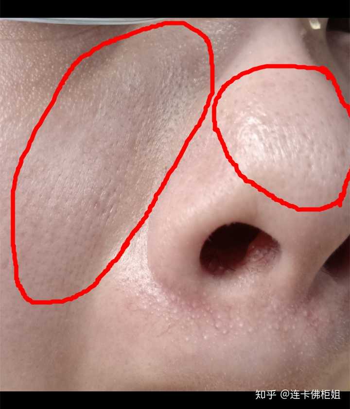 缺水的皮肤擦补水的化妆品时会刺痛是什么原理?