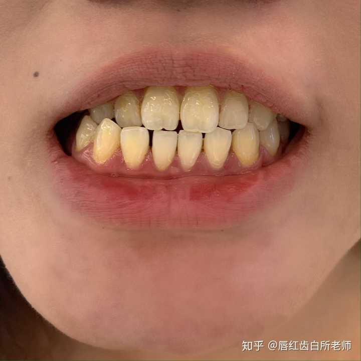 洗牙一般多少钱一次 知乎 洗牙一般多少钱一次 知乎