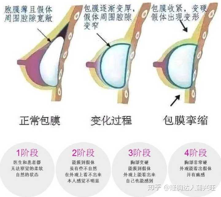 隆胸失败 一高一低图片