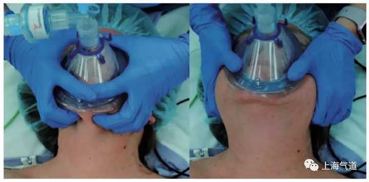 麻醉机上的挥发罐进入呼吸管路中,随着氧气从透明的呼吸面罩处喷出来