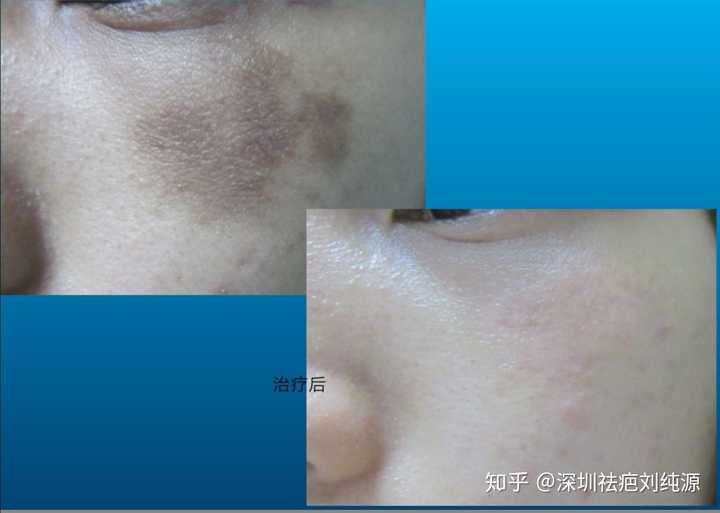 烫伤疤痕的黑色素怎么淡化?