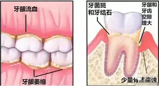 洗牙的过程是怎样的 洗牙后有哪些需要注意的 知乎