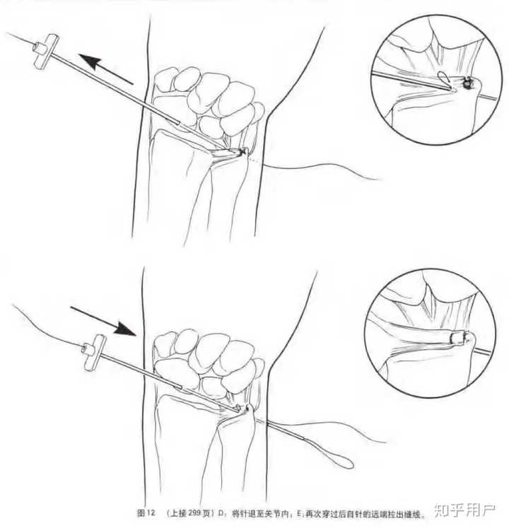 三角纤维软骨 Tfcc 损伤 该如何治疗和康复呢 知乎