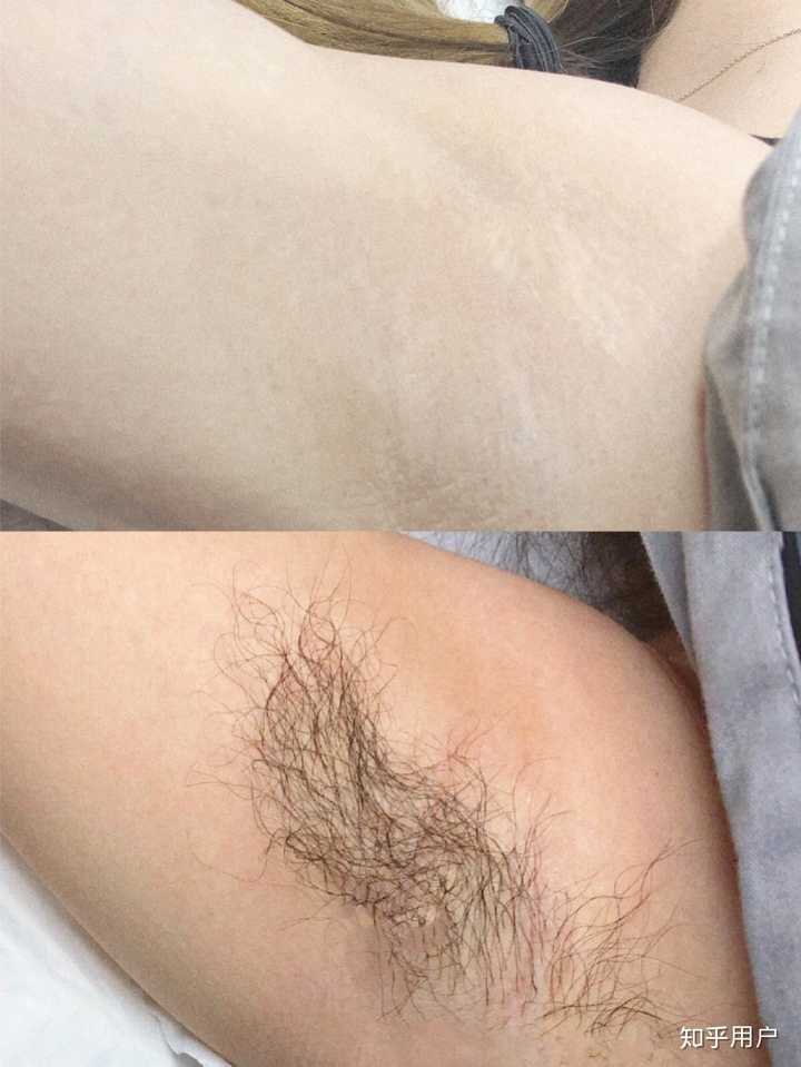 激光脱毛后色素沉着 知乎 激光脱毛后色素沉着 知乎