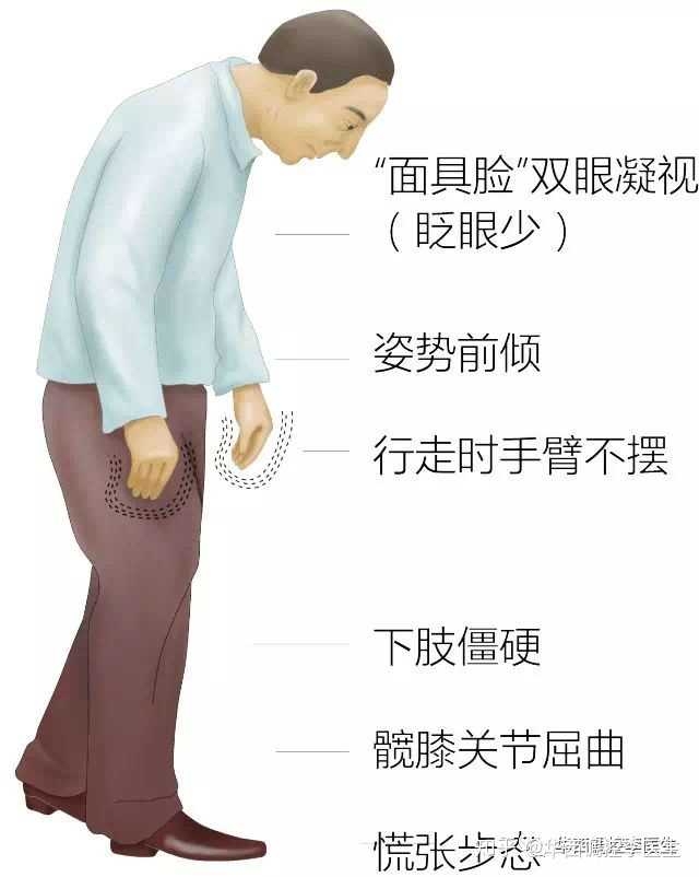 帕金森属于什么系统疾病呢?帕金森属于什么系统疾病呢? - 知乎