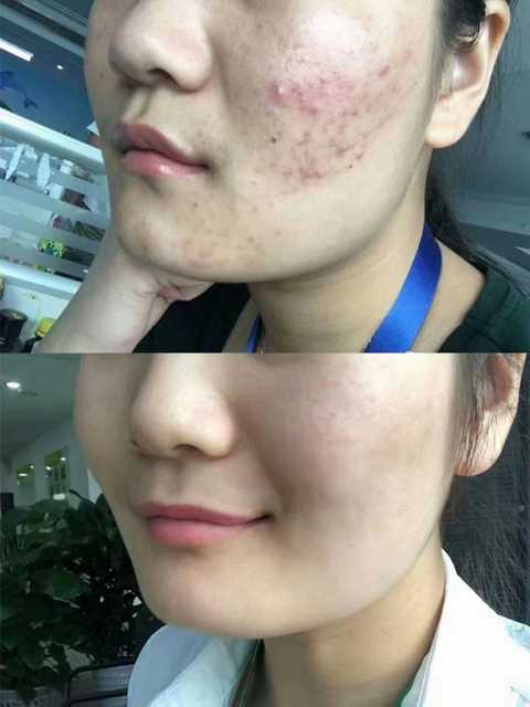 成人痘 知乎 成人痘 知乎