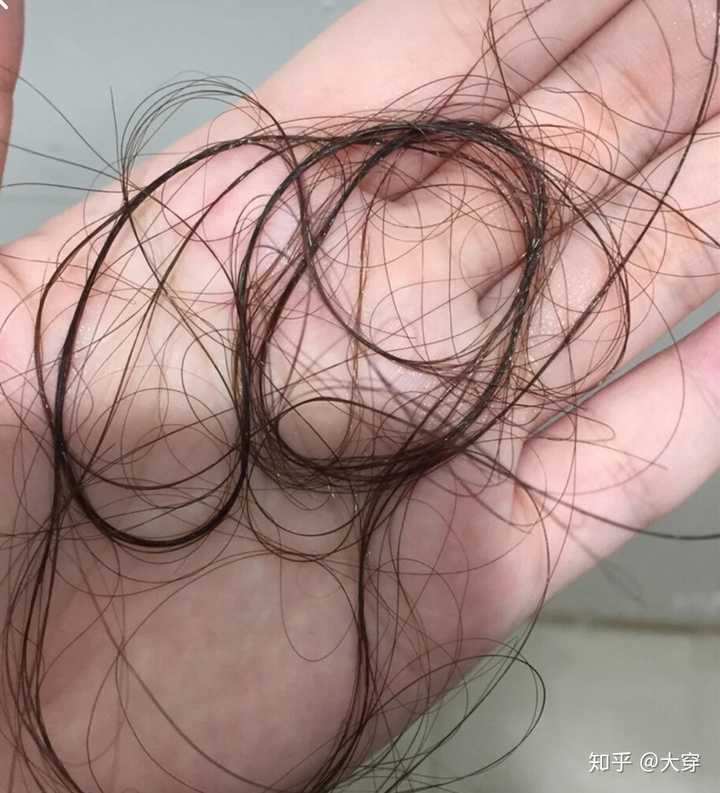 有什么治疗脱发亲测有效的方法