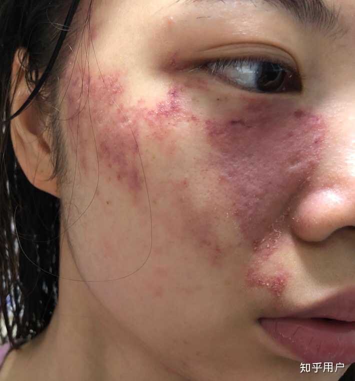 脸上有胎记是一种怎样的体验?