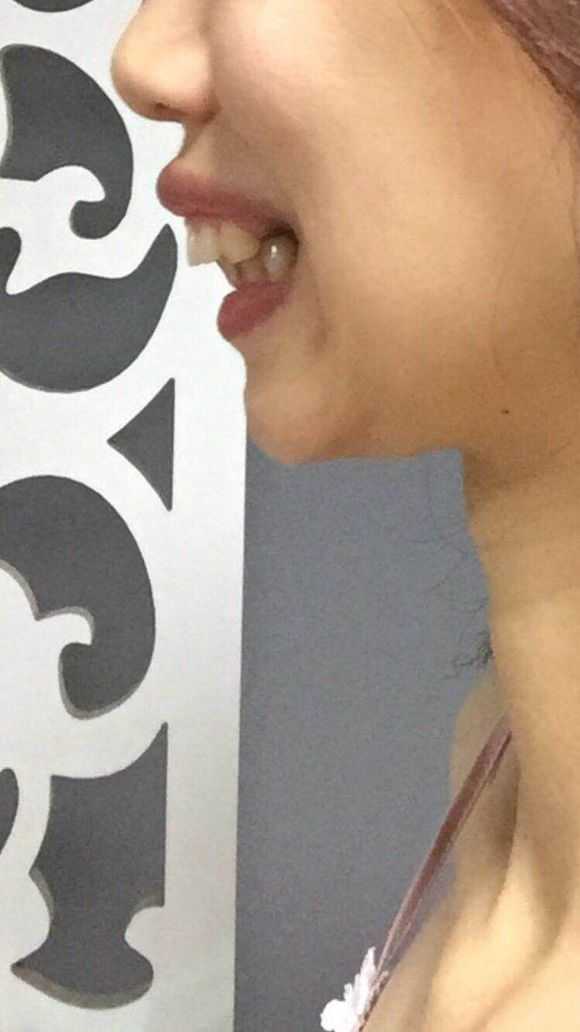 29岁女青年在深圳矫正牙齿,效果会怎么样?