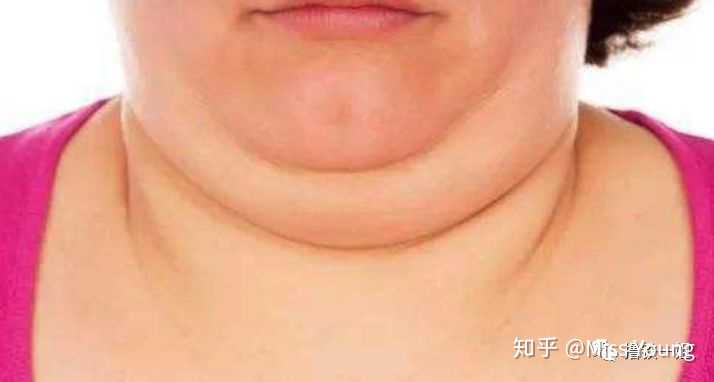 脖子粗是一种什么样的体验 如何改善这种问题 知乎