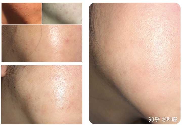 有哪些大神知道如何去脸上的闭口吗