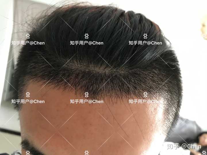 植发大概需要多少钱 知乎 植发大概需要多少钱 知乎