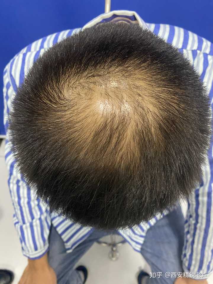 18岁两个发旋挨得比较近周围头发少正常吗