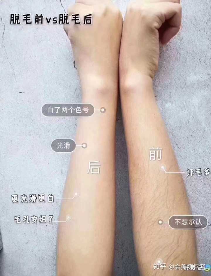问 脱毛仪对皮肤有害吗 知乎