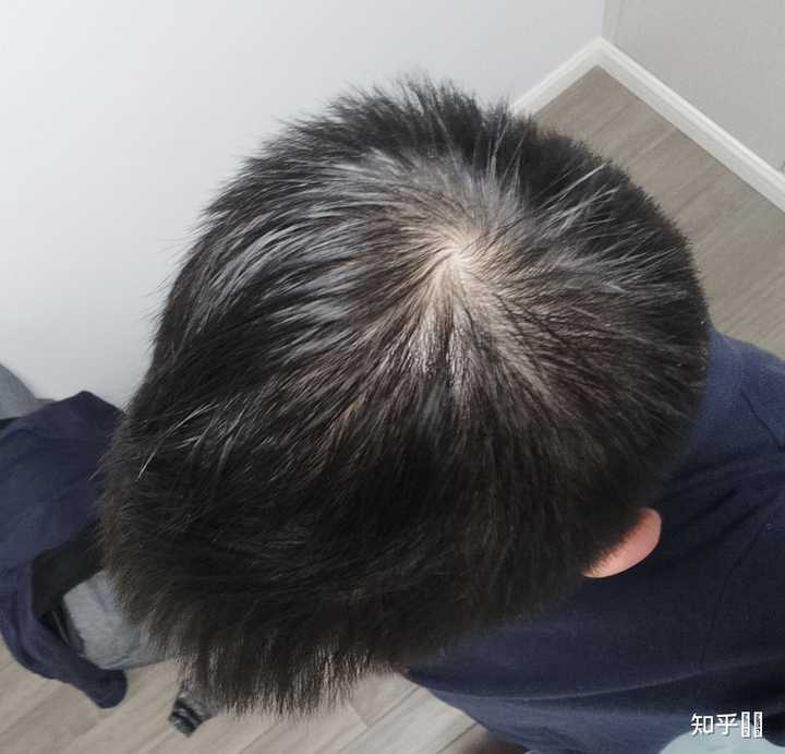 发旋处头发太少了！！！，我是不是要秃了，怎么办啊！？ - 知乎