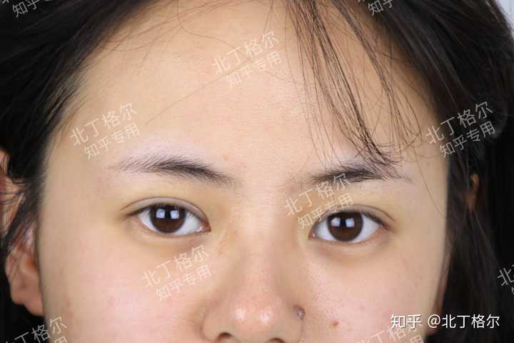 眼皮厚成这样还能拯救么?