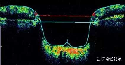 眼部oct检查怎么看 知乎