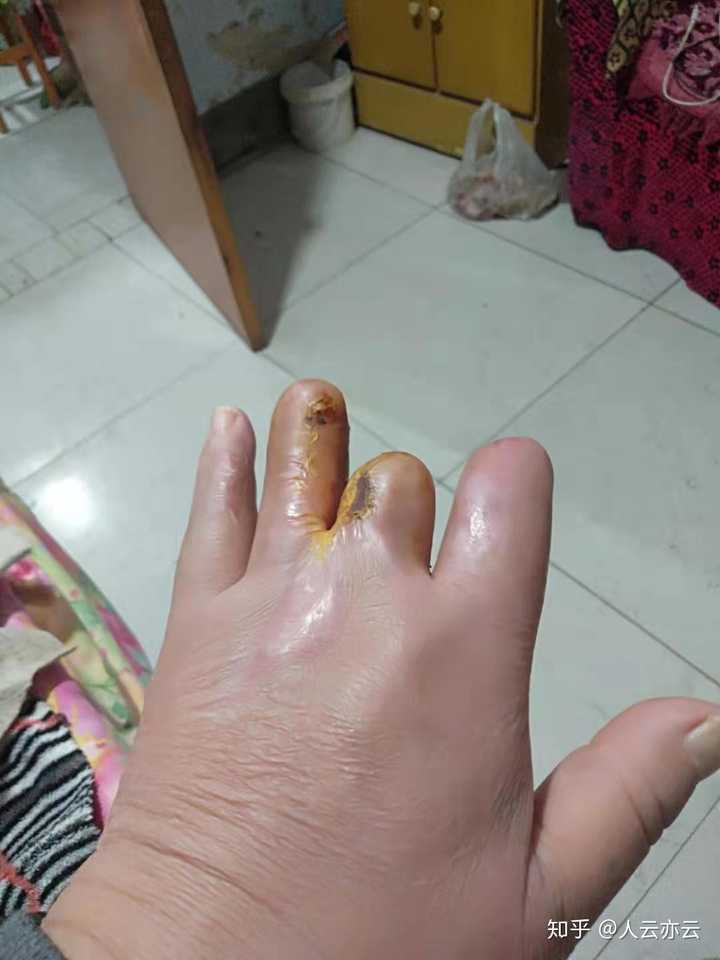 家里人年龄59岁去小厂子打工不慎被机器挤伤手指部分手指关节截断像