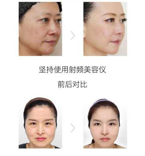 从医学角度来看 美容仪有用吗 知乎