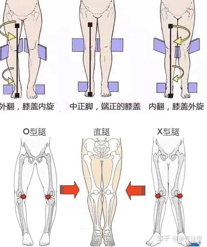 如何矫正罗圈腿 O型腿 知乎 如何矫正罗圈腿 O型腿 知乎
