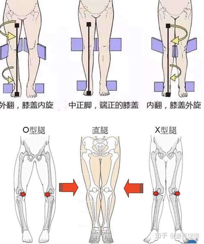 如何矫正罗圈腿 O型腿 知乎