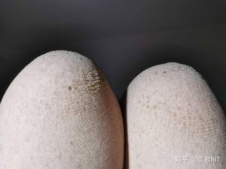 鱼鳞病还有未来吗 知乎
