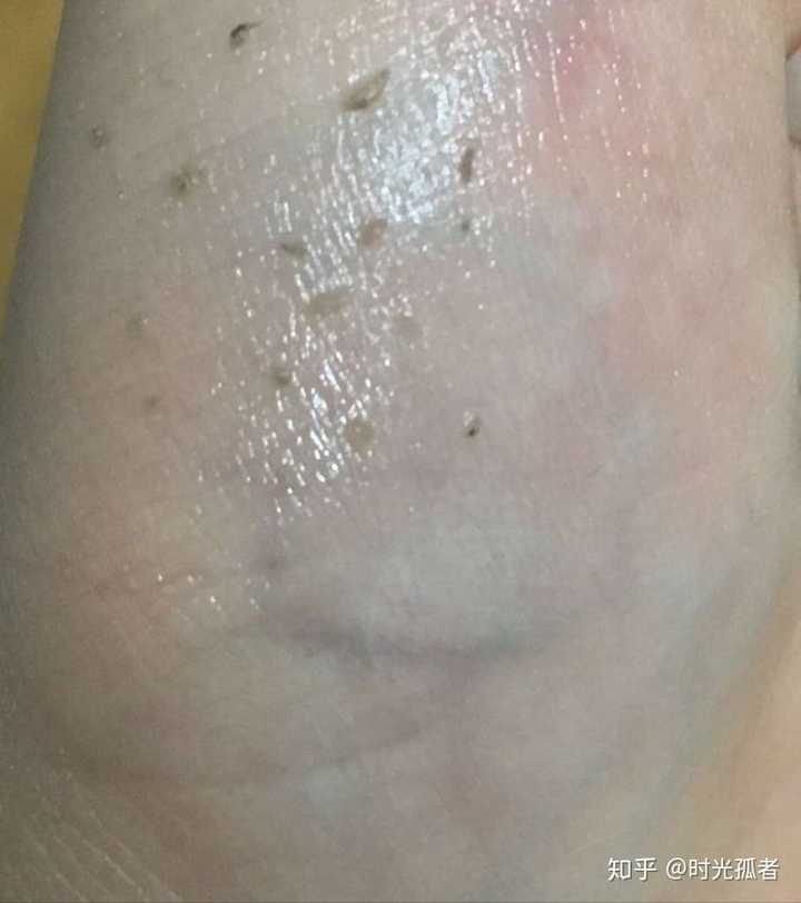 用手按摩,揉出的黑头