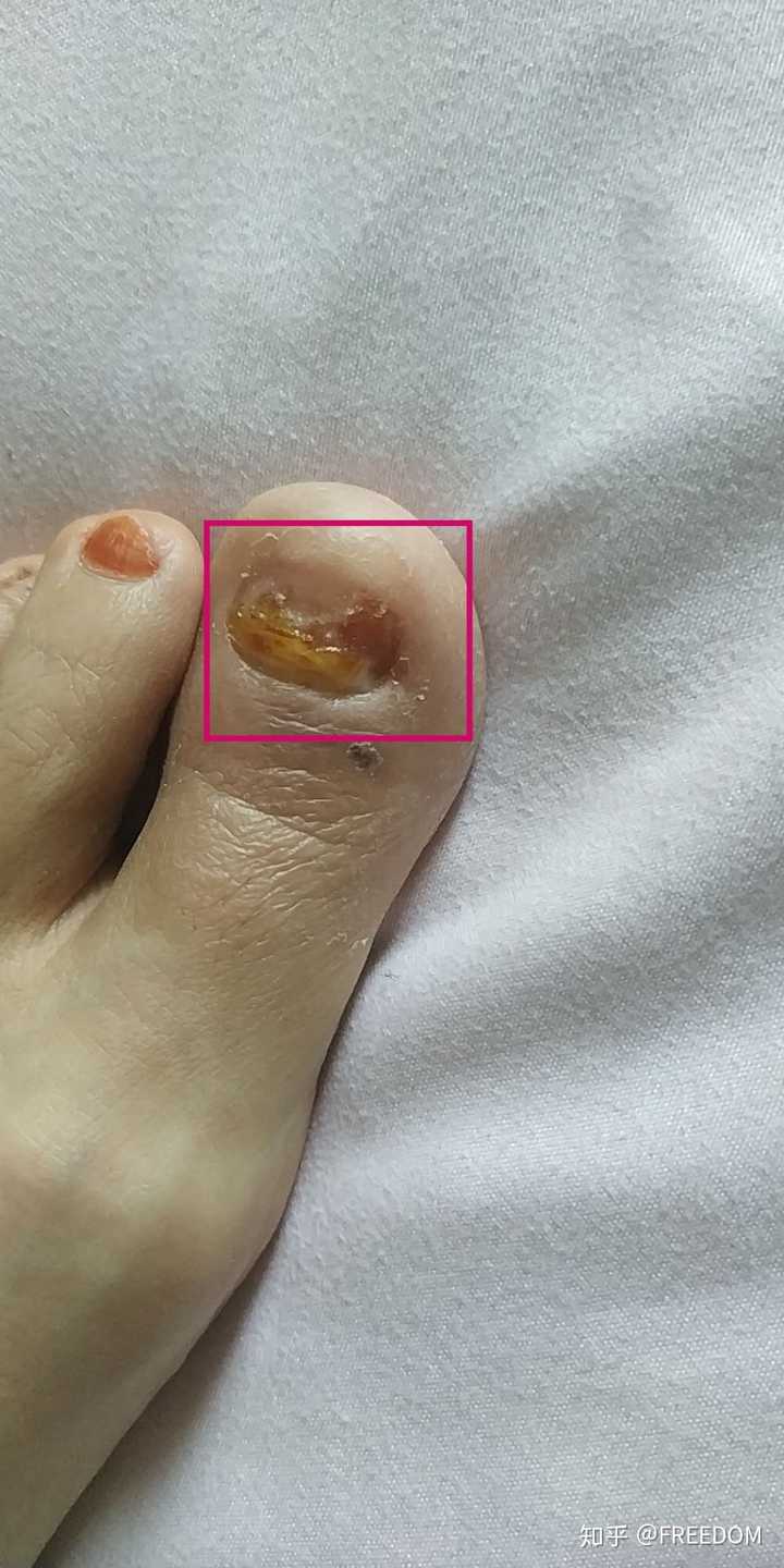灰指甲真的这么难治吗 知乎 灰指甲真的这么难治吗 知乎