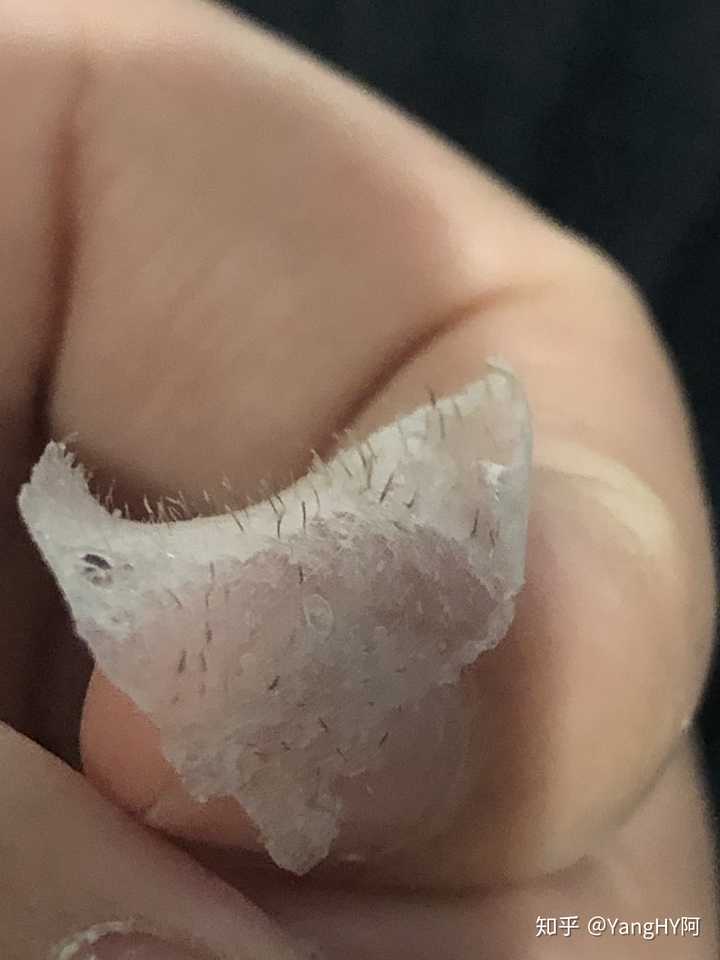 史上最大的黑头有多大?