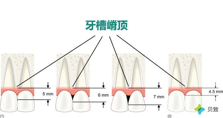 箍牙时怎么避免黑三角?