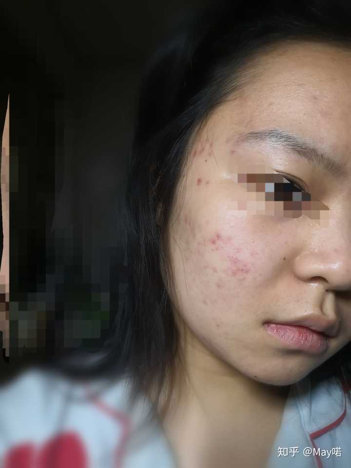 有亲身治疗脸上痘痘治好的吗?