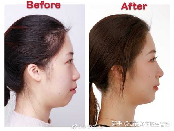西安矫正医生曹甜 的想法: #矫正前后对比# 来自患者的侧貌对比分享
