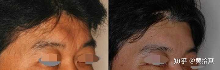 额头难看眉骨高怎么办 知乎